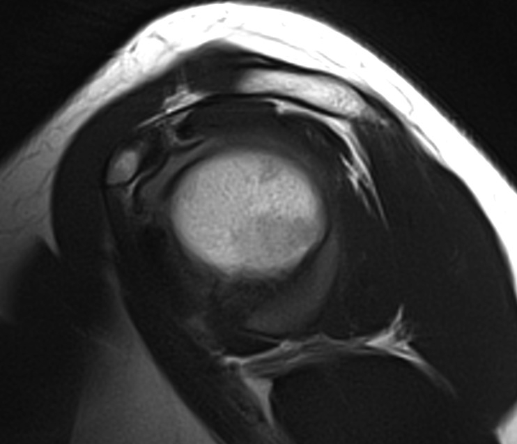 Axillary Nerve Sagittal MRI 1